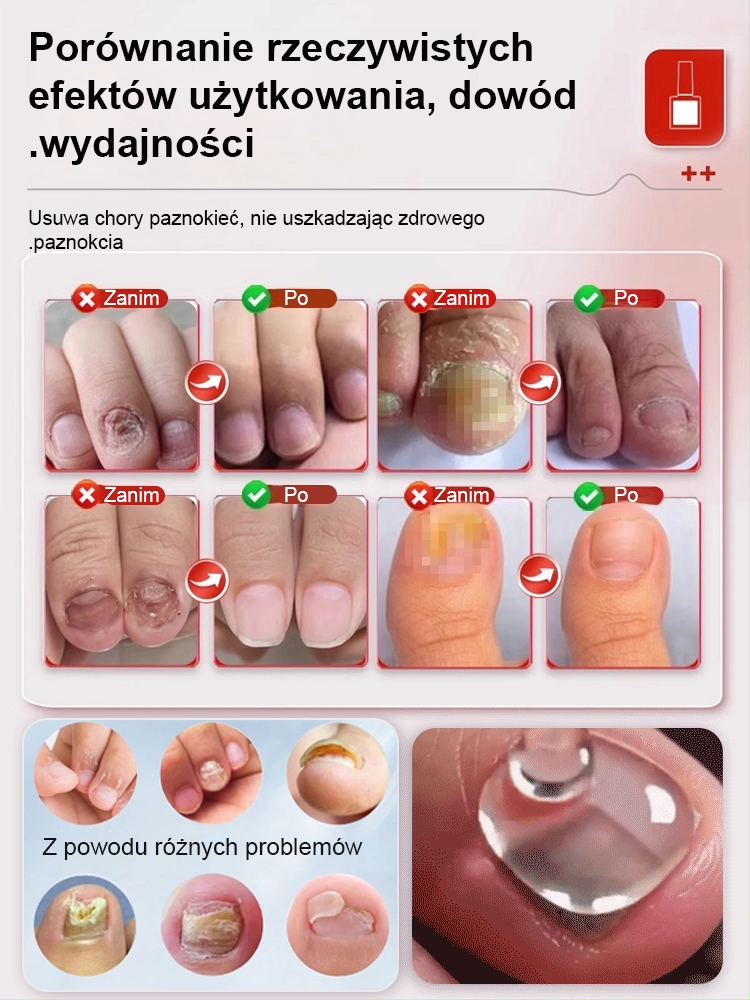 JC przeciwgrzybiczy płyn do regeneracji paznokci